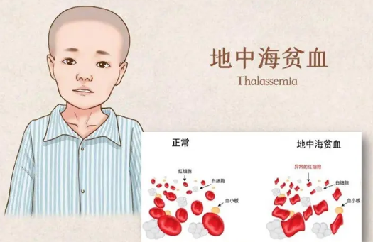 护理园地|地中海贫血护理知识分享 护理园地|地中海贫血护理知识分享