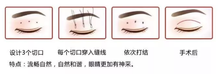 大众科普|眼周美容微整形攻略,请您查收~ 大众科普|眼周美容微整形攻略,请您查收~