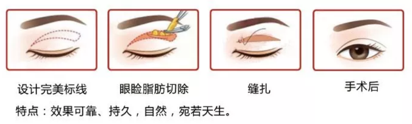 大众科普|眼周美容微整形攻略,请您查收~ 大众科普|眼周美容微整形攻略,请您查收~