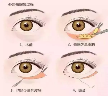 大众科普|眼周美容微整形攻略,请您查收~ 大众科普|眼周美容微整形攻略,请您查收~