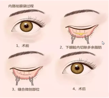 大众科普|眼周美容微整形攻略,请您查收~ 大众科普|眼周美容微整形攻略,请您查收~