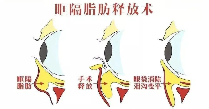 大众科普|眼周美容微整形攻略,请您查收~ 大众科普|眼周美容微整形攻略,请您查收~