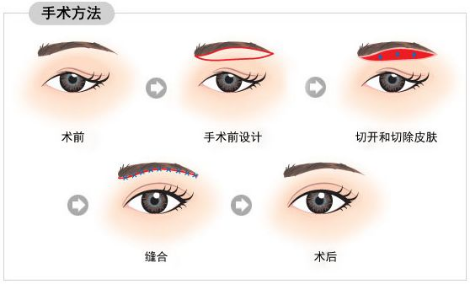 大众科普|眼周美容微整形攻略,请您查收~ 大众科普|眼周美容微整形攻略,请您查收~