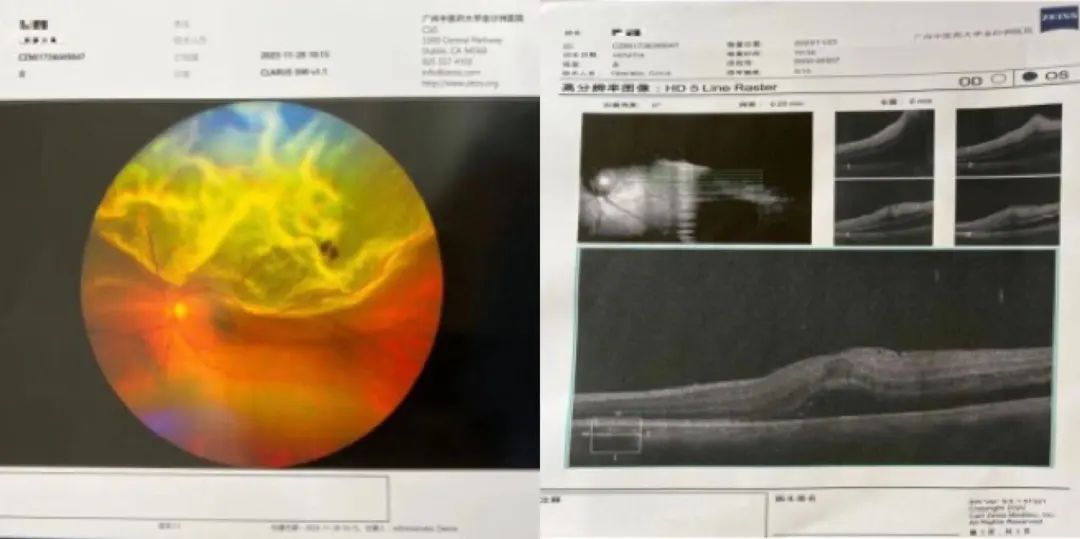 病例分享|突破光明禁区:广州中医药大学金沙洲医院眼科中心首例微创玻璃体视网膜手术 病例分享|突破光明禁区:广州中医药大学金沙洲医院眼科中心首例微创玻璃体视网膜手术