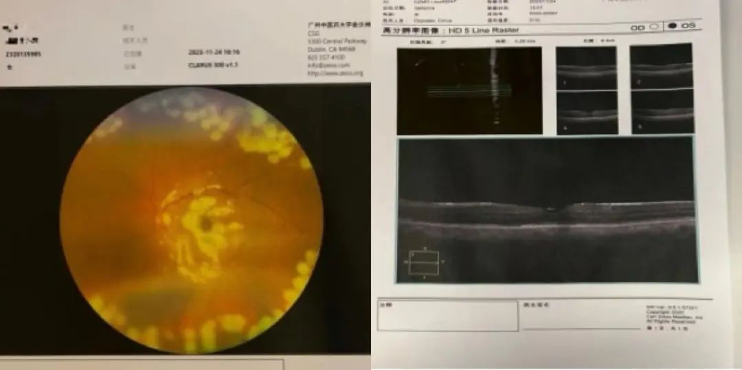 病例分享|突破光明禁区:广州中医药大学金沙洲医院眼科中心首例微创玻璃体视网膜手术 病例分享|突破光明禁区:广州中医药大学金沙洲医院眼科中心首例微创玻璃体视网膜手术