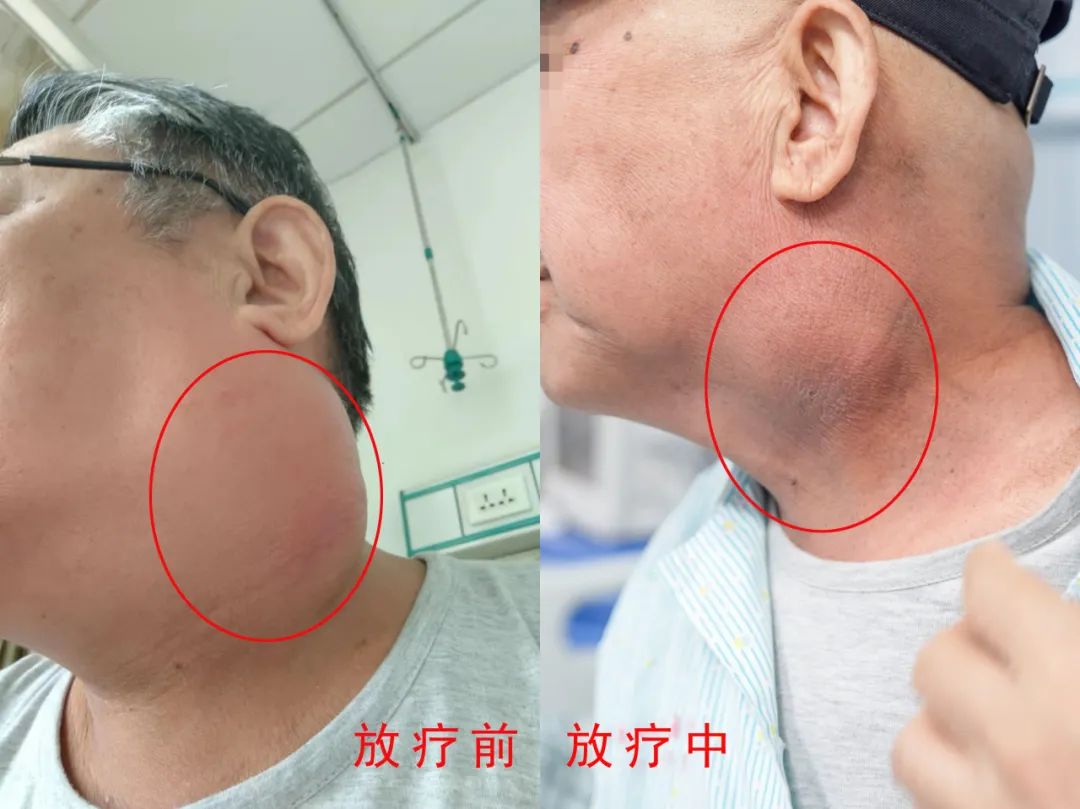 病例分享|个性化精准方案缩瘤,患者连送锦旗致谢 病例分享|个性化精准方案缩瘤,患者连送锦旗致谢