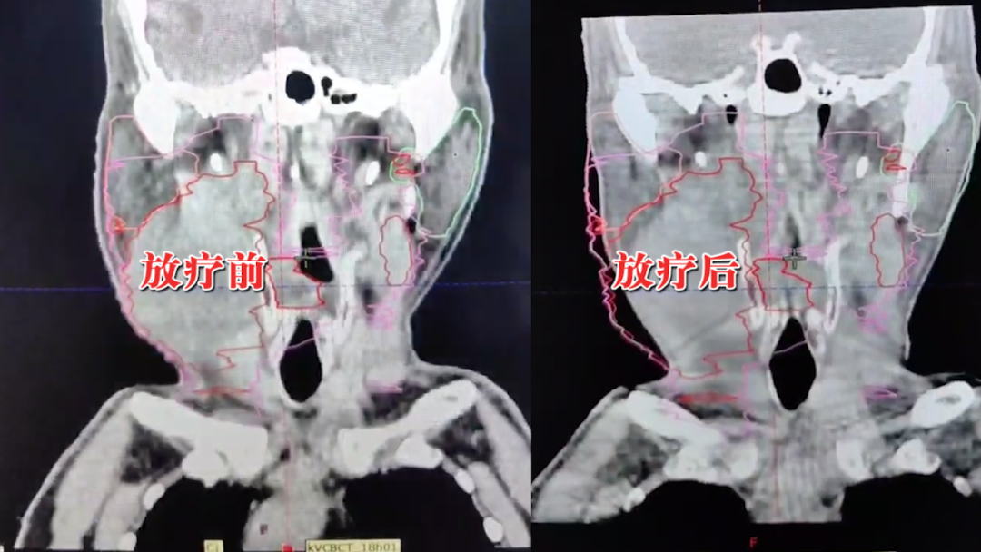 病例分享|个性化精准方案缩瘤,患者连送锦旗致谢 病例分享|个性化精准方案缩瘤,患者连送锦旗致谢
