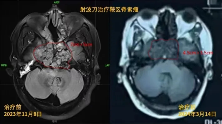 病例分享|长在大脑深处的肿瘤,不开刀也能“切” 病例分享|长在大脑深处的肿瘤,不开刀也能“切”