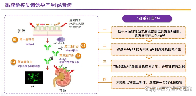 布地奈德缓释胶囊(Nefecon)在IgA肾病的应用 布地奈德缓释胶囊(Nefecon)在IgA肾病的应用