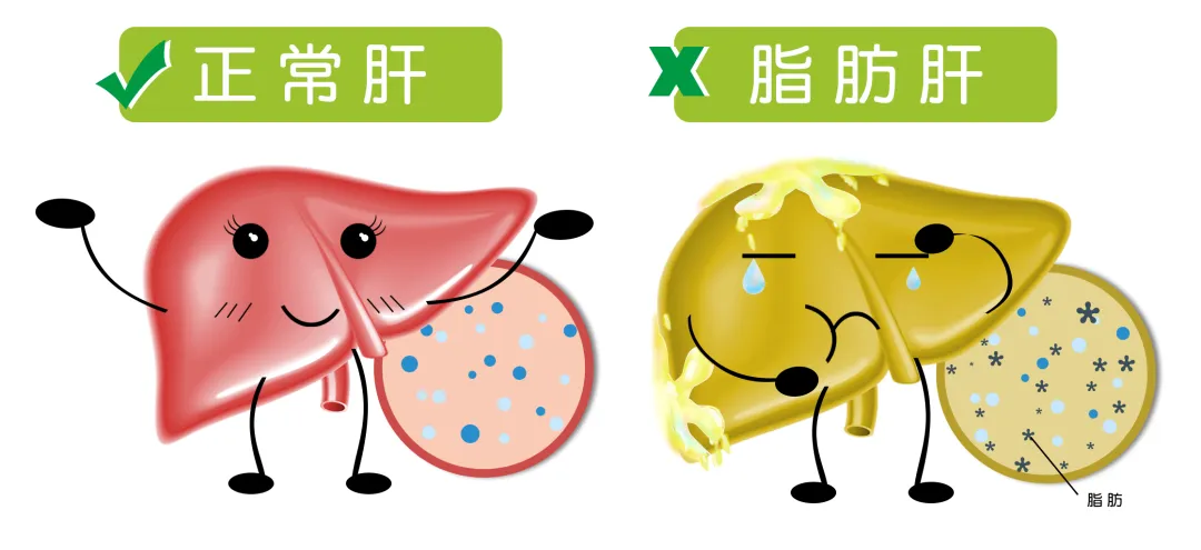 护理园地|脂肪肝不是胖人专属,爱肝护肝“消”得快 护理园地|脂肪肝不是胖人专属,爱肝护肝“消”得快