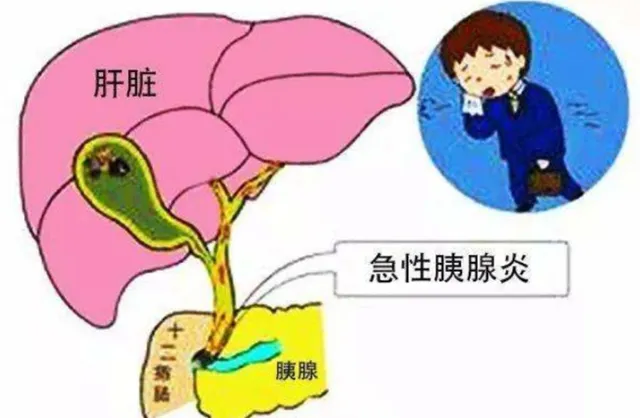 大众科普|来势汹汹的急性胰腺炎,您了解吗? 大众科普|来势汹汹的急性胰腺炎,您了解吗?