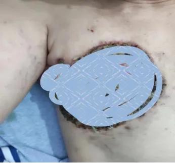 病例分享|肿瘤医生忠告：按摩乳房肿块要小心！！！