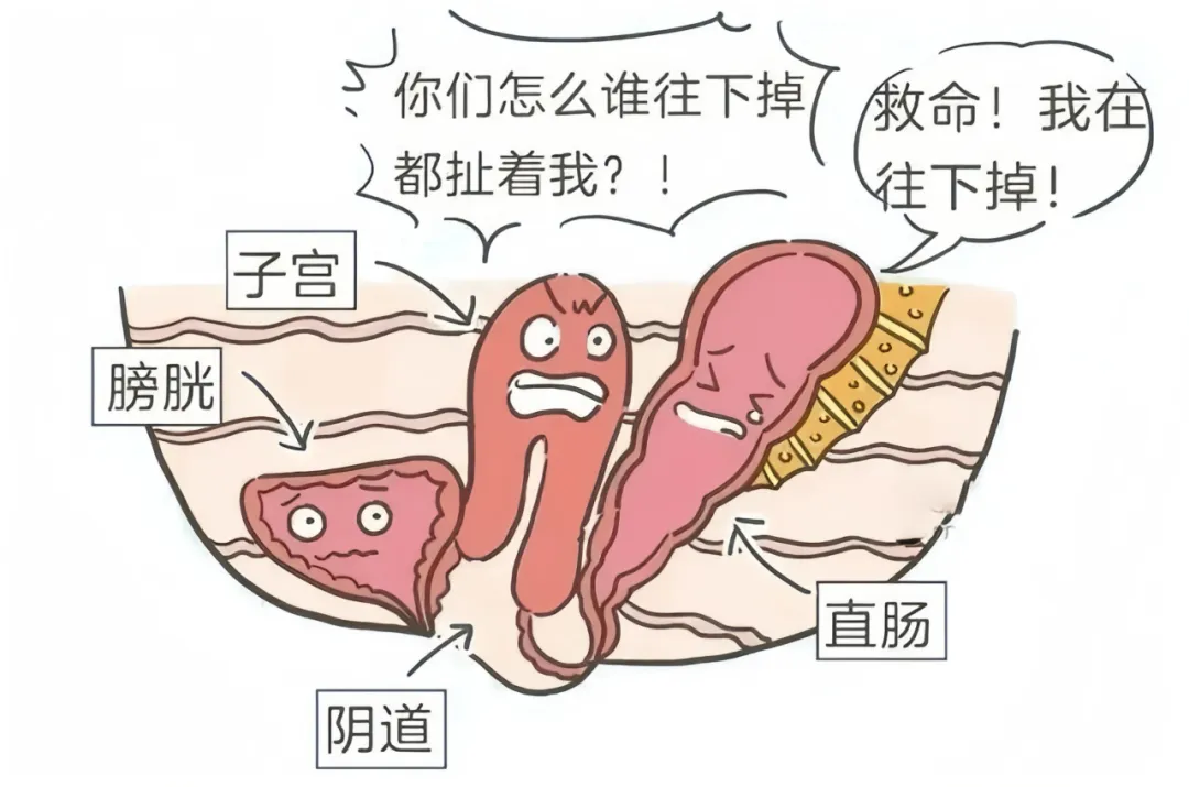 大众科普|一文带您了解“掉”下来的难言之隐---子宫阴道脱垂 大众科普|一文带您了解“掉”下来的难言之隐---子宫阴道脱垂