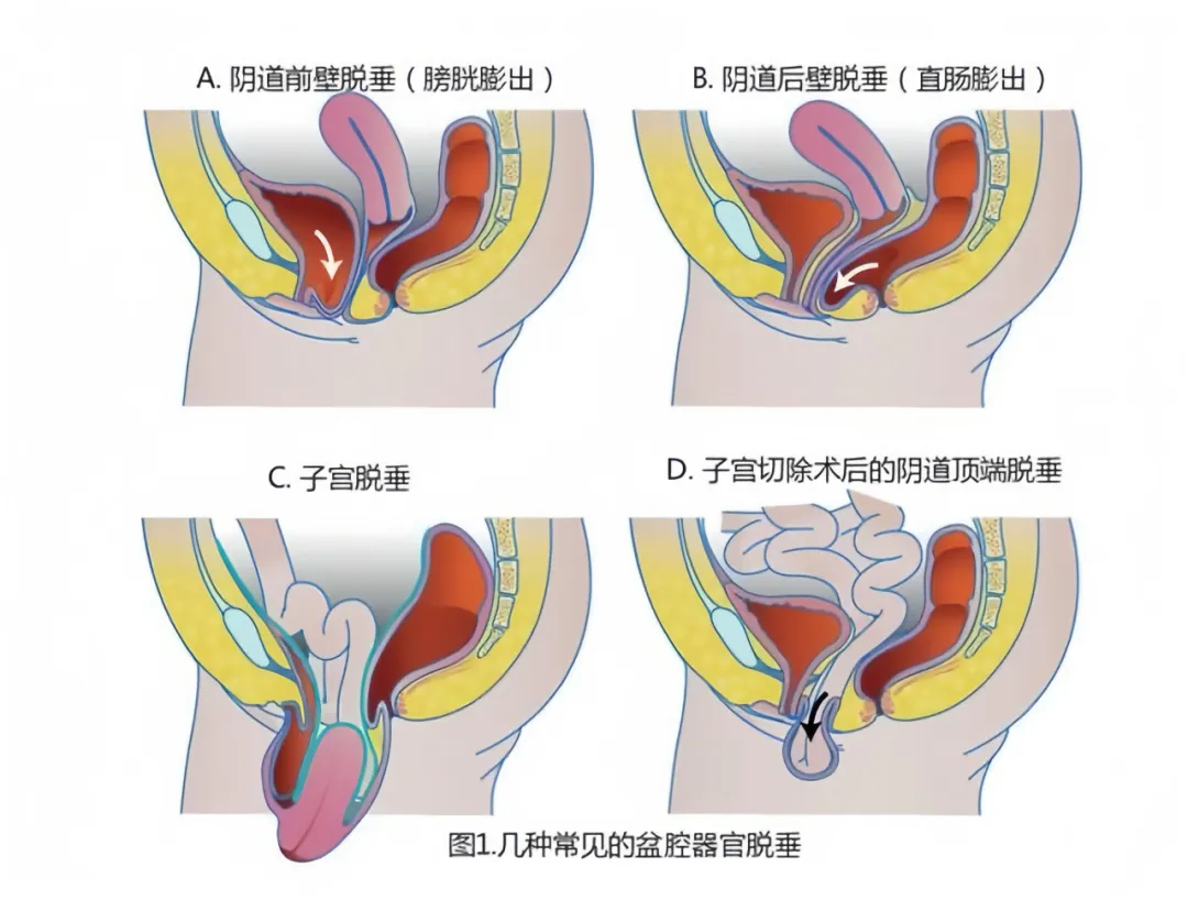 大众科普|一文带您了解“掉”下来的难言之隐---子宫阴道脱垂 大众科普|一文带您了解“掉”下来的难言之隐---子宫阴道脱垂