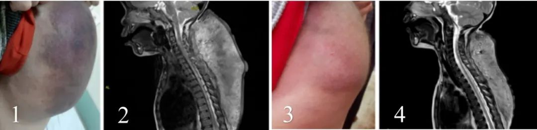 Case Study | Importance of immunoassay for rapamycin