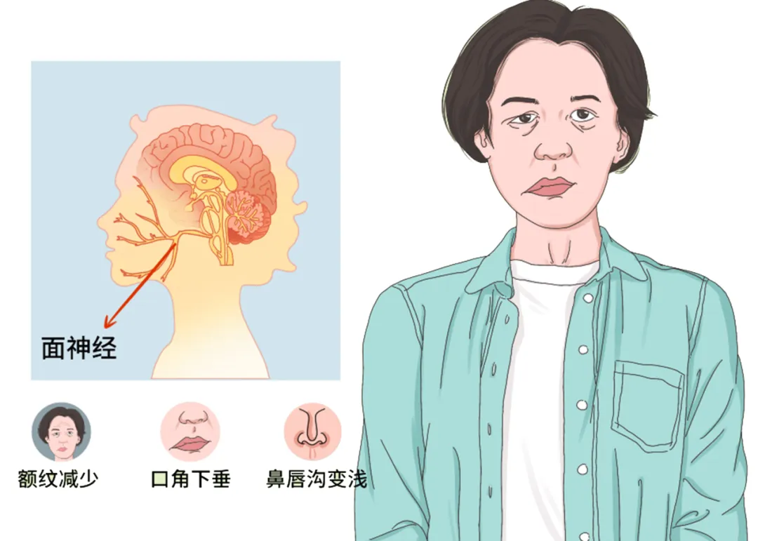 大众科普|睡一觉起来脸歪了,小心面神经炎 大众科普|睡一觉起来脸歪了,小心面神经炎