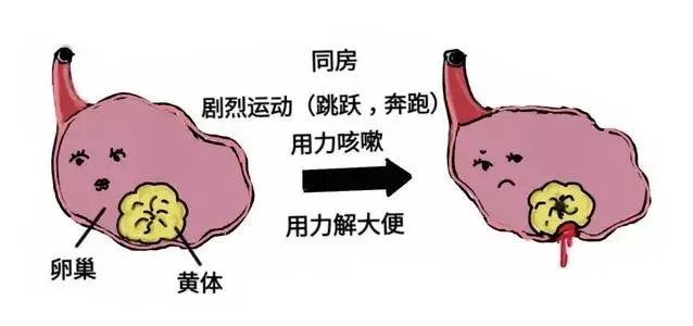 大众科普|带你走进卵巢黄体破裂的世界 大众科普|带你走进卵巢黄体破裂的世界
