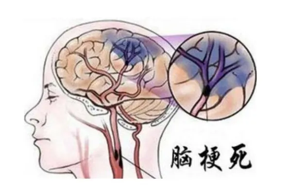 护理园地|脑梗患者护理六要点要谨记 护理园地|脑梗患者护理六要点要谨记
