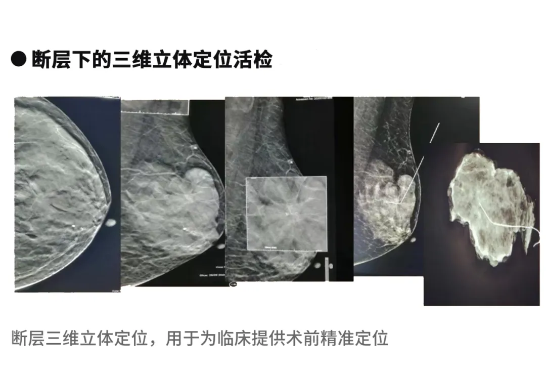 大众科普|守护乳腺健康,了解乳腺X线断层摄影 大众科普|守护乳腺健康,了解乳腺X线断层摄影