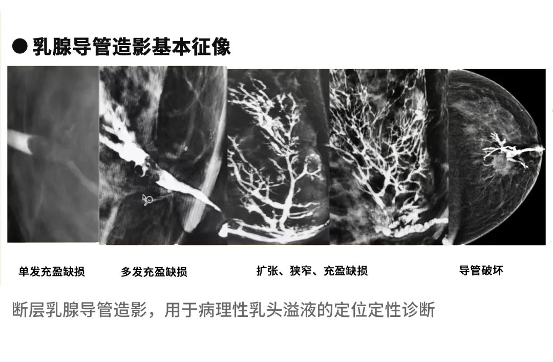 大众科普|守护乳腺健康,了解乳腺X线断层摄影 大众科普|守护乳腺健康,了解乳腺X线断层摄影