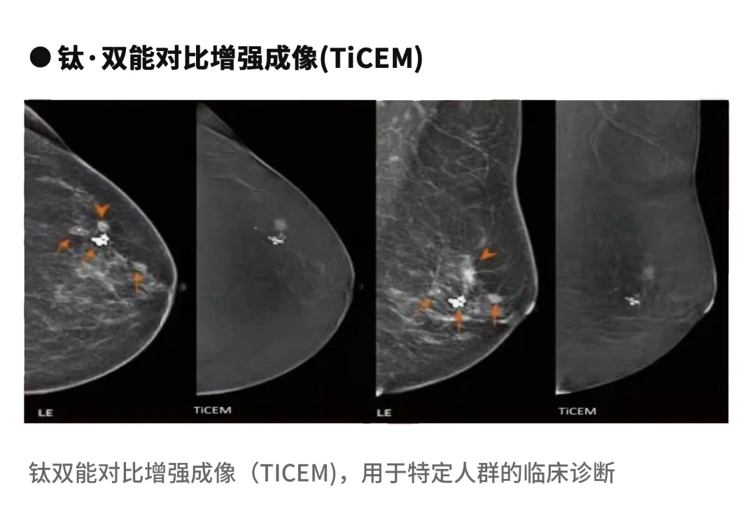 大众科普|守护乳腺健康,了解乳腺X线断层摄影 大众科普|守护乳腺健康,了解乳腺X线断层摄影