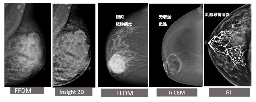 大众科普|守护乳腺健康,了解乳腺X线断层摄影 大众科普|守护乳腺健康,了解乳腺X线断层摄影