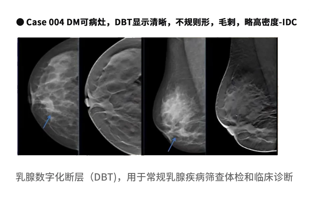 大众科普|守护乳腺健康,了解乳腺X线断层摄影 大众科普|守护乳腺健康,了解乳腺X线断层摄影