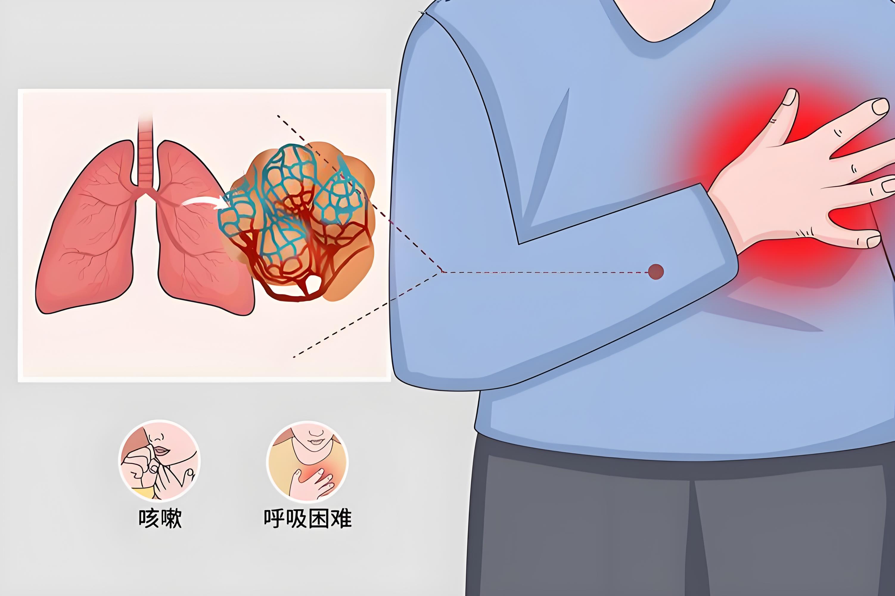 重磅积极信号,IPF有望进入吸入治疗时代! “瑞思普利”自主研发的RSN0402吸入粉雾剂成功完成I期临床首例受试者入组 重磅积极信号,IPF有望进入吸入治疗时代! “瑞思普利”自主研发的RSN0402吸入粉雾剂成功完成I期临床首例受试者入组