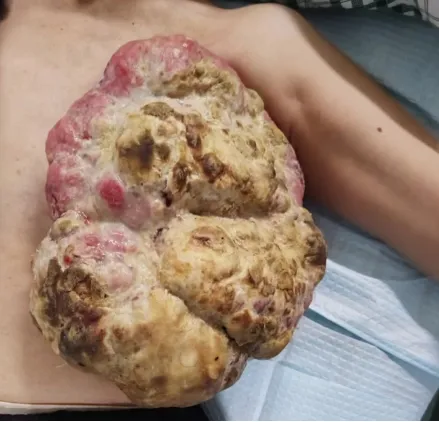 乳腺癌丨治疗策略对了,再难也有机会消除 乳腺癌丨治疗策略对了,再难也有机会消除