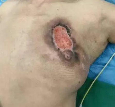 乳腺癌丨治疗策略对了,再难也有机会消除 乳腺癌丨治疗策略对了,再难也有机会消除