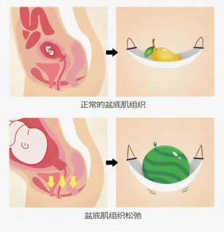关爱女性,乐享健康 --- 妇科盆底修复 关爱女性,乐享健康 --- 妇科盆底修复
