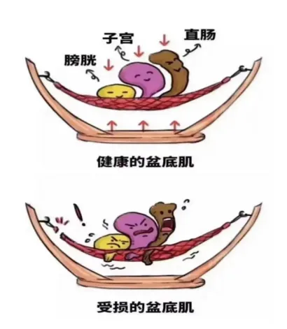 关爱女性,乐享健康 --- 妇科盆底修复 关爱女性,乐享健康 --- 妇科盆底修复