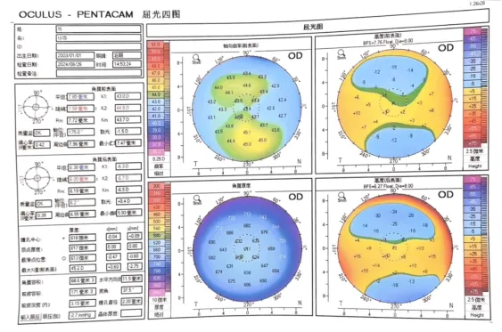 大众科普|一文带您了解全飞秒激光手术 大众科普|一文带您了解全飞秒激光手术