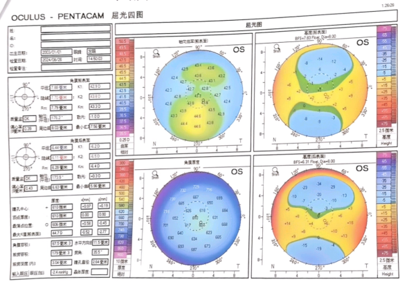 大众科普|一文带您了解全飞秒激光手术 大众科普|一文带您了解全飞秒激光手术