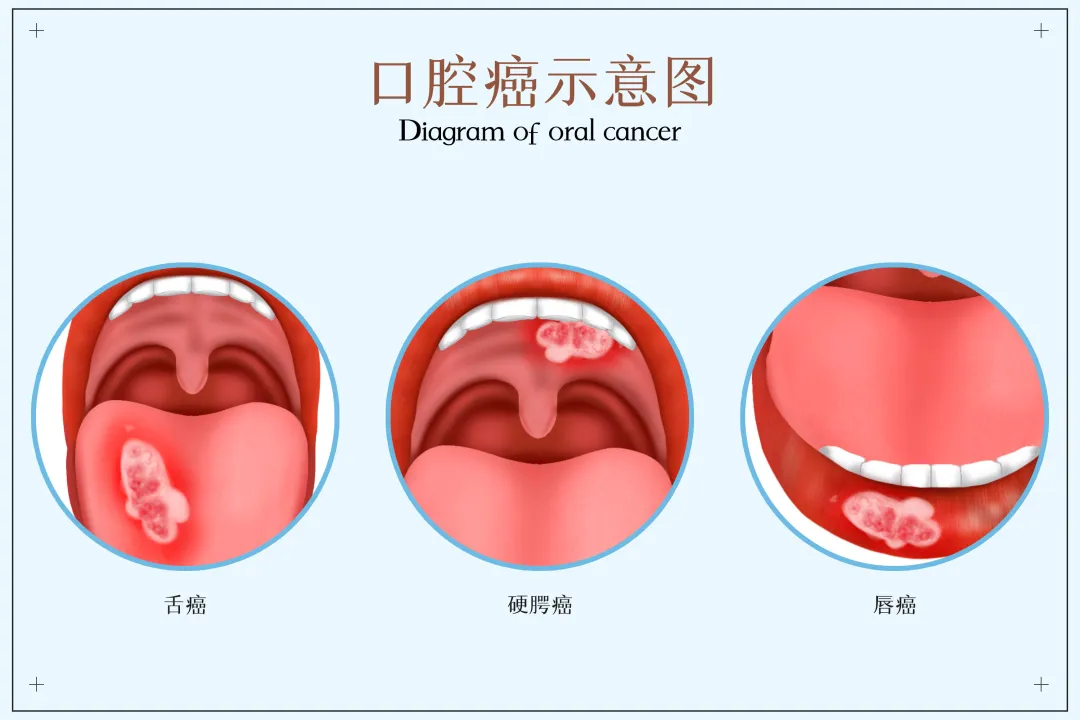 大众科普|可防可治的口腔癌,您了解多少? 大众科普|可防可治的口腔癌,您了解多少?