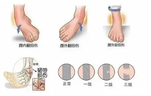 骨科科普|不小心脚崴了?正确处理助你 “站稳脚跟” 骨科科普|不小心脚崴了?正确处理助你 “站稳脚跟”