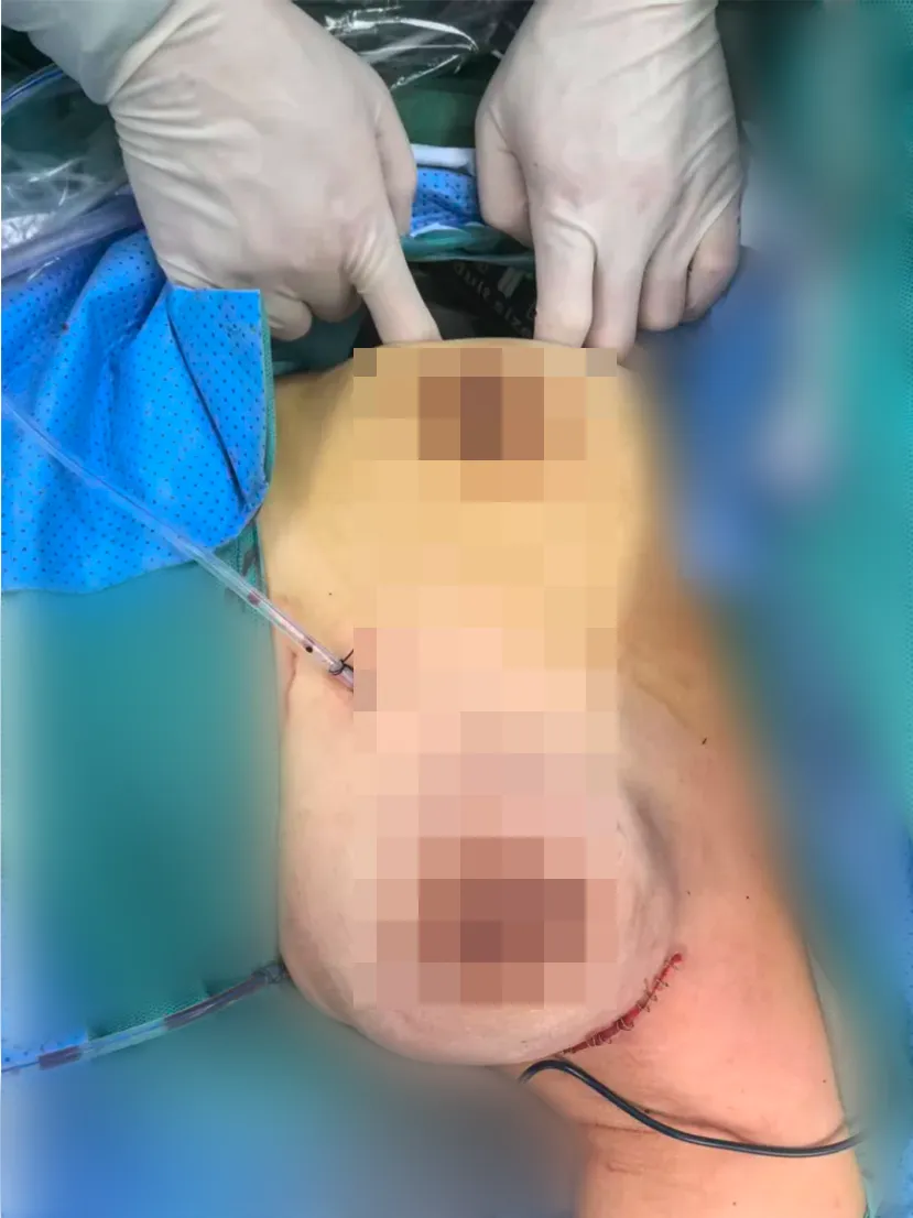 重塑美丽 守护健康——腔镜乳腺癌手术+乳房假体植入术,让治疗与美学并存,治病不伤“心” 重塑美丽 守护健康——腔镜乳腺癌手术+乳房假体植入术,让治疗与美学并存,治病不伤“心”