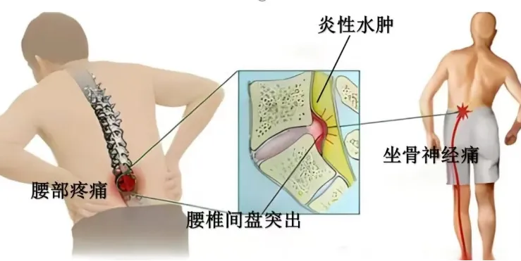 精微除顽疾 脊护健康行|香港宝典宝典免费资料大全骨科微创UBE技术为腰椎间盘突出患者重启无痛人生 精微除顽疾 脊护健康行|香港宝典宝典免费资料大全骨科微创UBE技术为腰椎间盘突出患者重启无痛人生