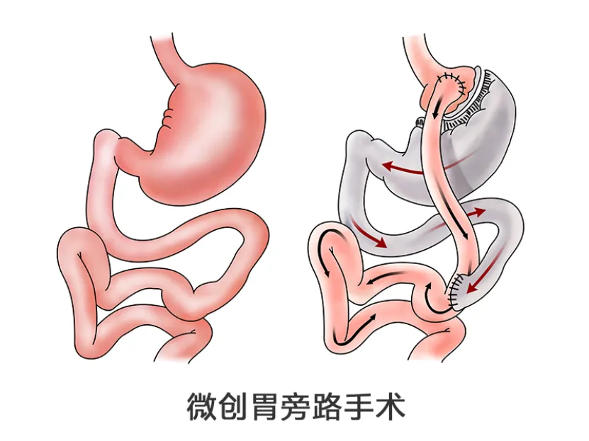 病例分享|16岁少年与糖尿病斗争和重获新生的故事