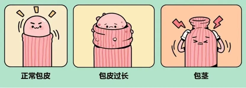 大众科普|暑期割包皮全攻略:家长必看指南 大众科普|暑期割包皮全攻略:家长必看指南