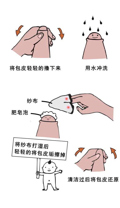 大众科普|暑期割包皮全攻略:家长必看指南 大众科普|暑期割包皮全攻略:家长必看指南