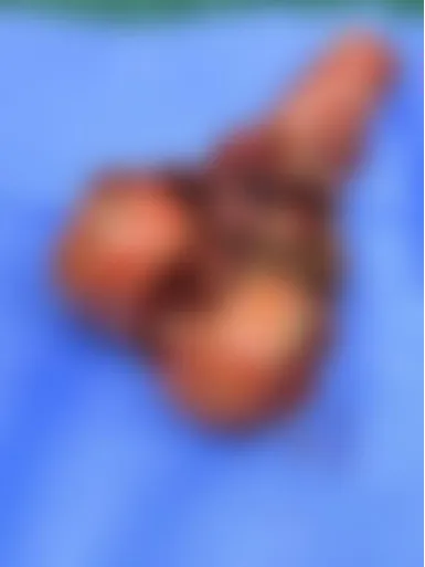 病例分享|16岁骨肉瘤少年的重生:换膝术后,重新迈出人生步伐 病例分享|16岁骨肉瘤少年的重生:换膝术后,重新迈出人生步伐